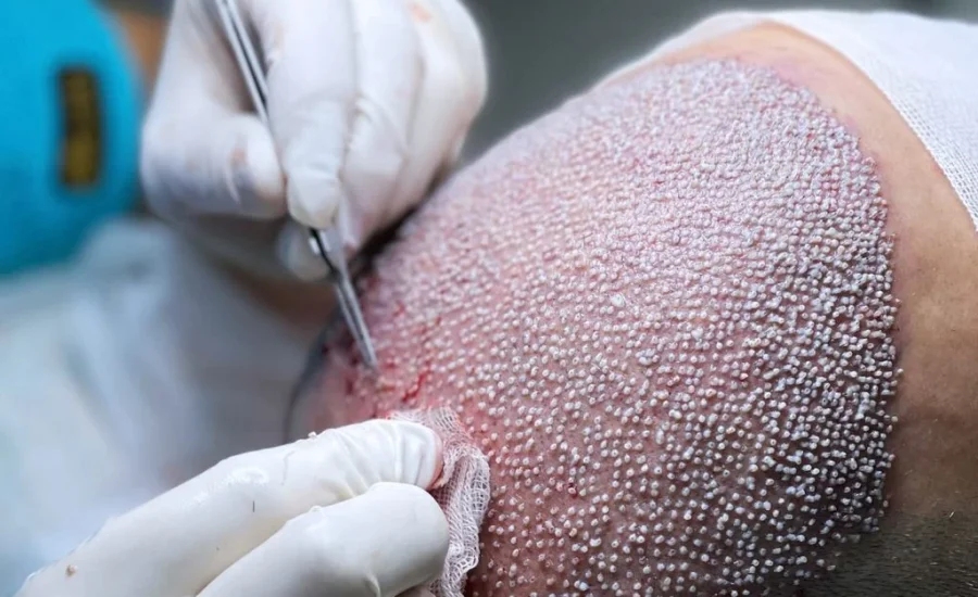 تقنية FUE لزراعة الشعر
