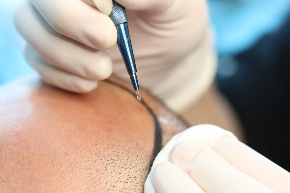 زراعة الشعر بتقنية السفير