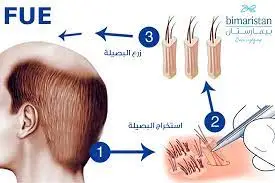 تقنية FUE لزراعة الشعر