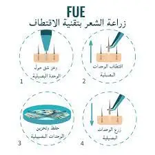 تقنية FUE لزراعة الشعر