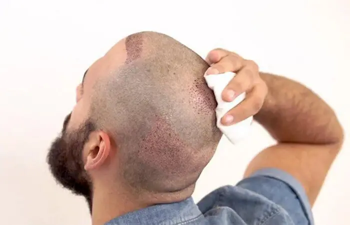 التعامل مع الألم بعد زراعة الشعر