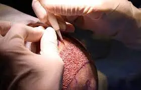 تقنية أقلام تشوي