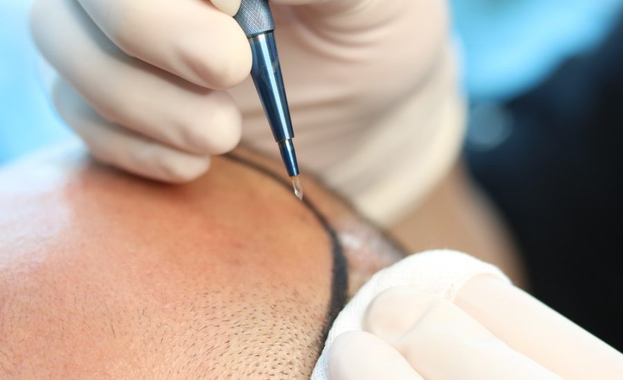 زراعة الشعر بتقنية السفير