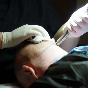 تقنية FUE لزراعة الشعر